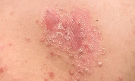 Kondisi Kulit Yang Terkena Eksim Atau Dermatitis Atopik