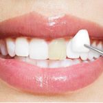 Prosedur Estetika Gigi Dalam Melakukan Veneer