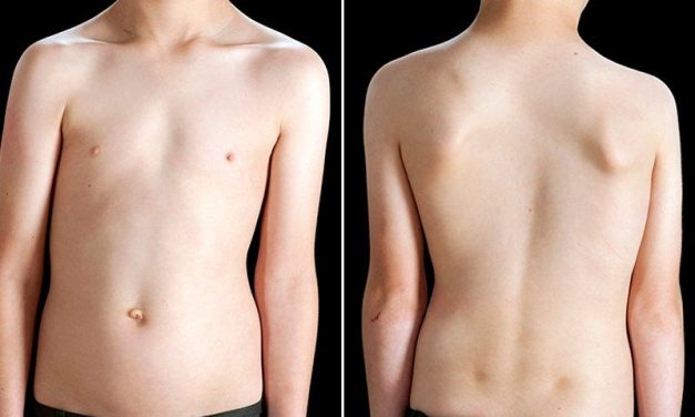 Kondisi Tubuh Skoliosis Kelainan Tulang Belakang